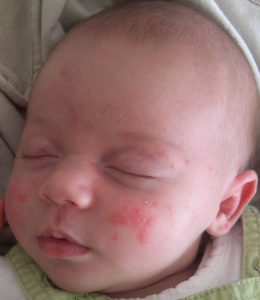 Baby acne