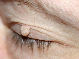 Eye skin tags