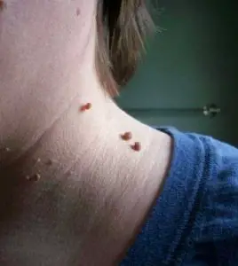 Growth on Neck
