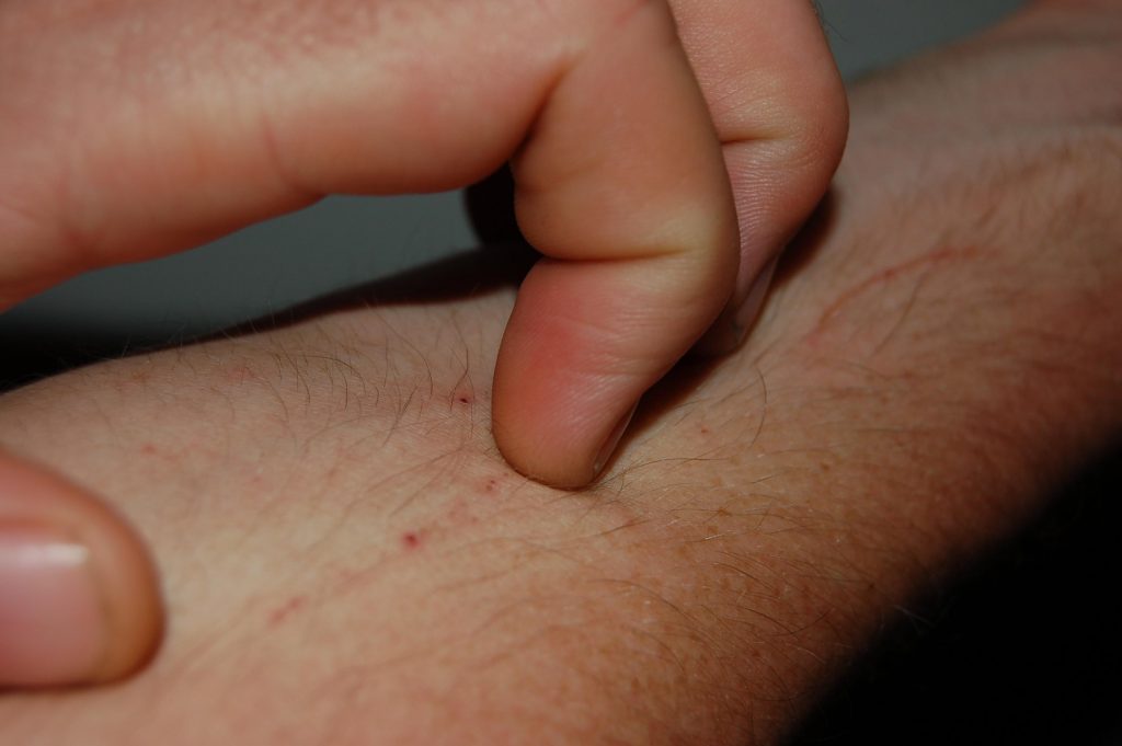 What Can Cause Itchy Skin without Rash?