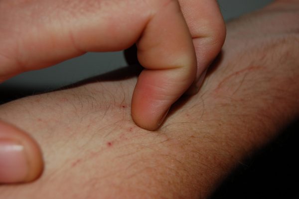 What Can Cause Itchy Skin without Rash? 