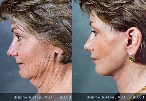 How to Tighten Skin under Chin after Weight Loss