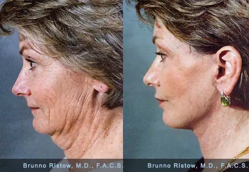 Loose Skin Under Chin Core Plastic Surgery