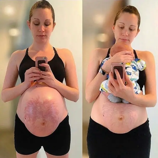 How To Get Rid Of Stretched Skin After Pregnancy Extensive Answer