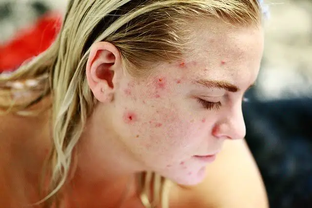 skin after accutane