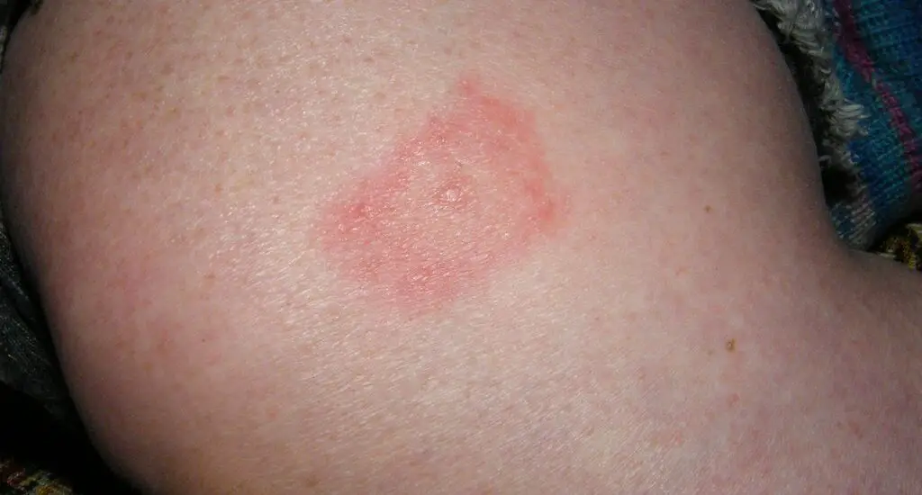 Skin After a Tick Bite