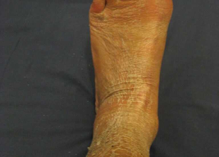 skin after cast