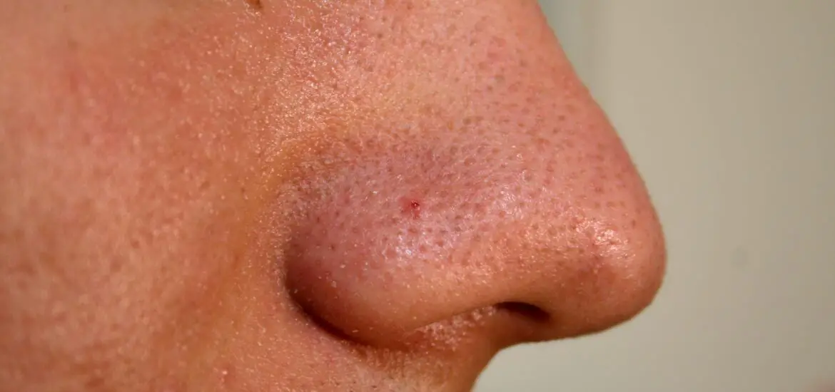 Skin After Blackhead Removal