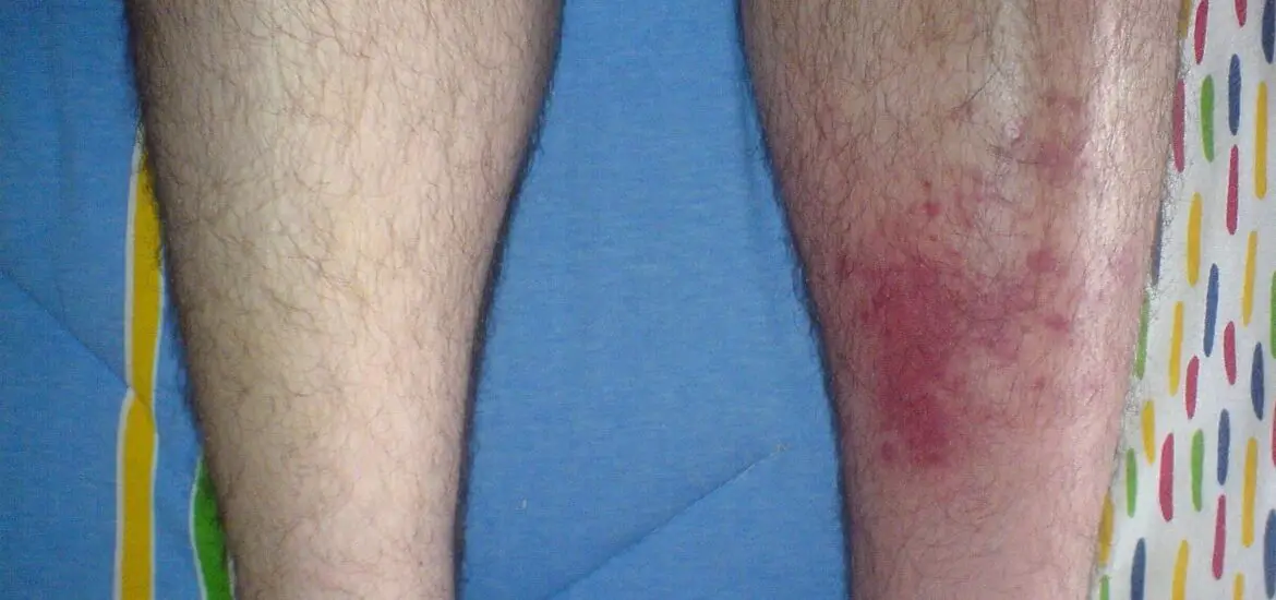 Skin After Cellulitis