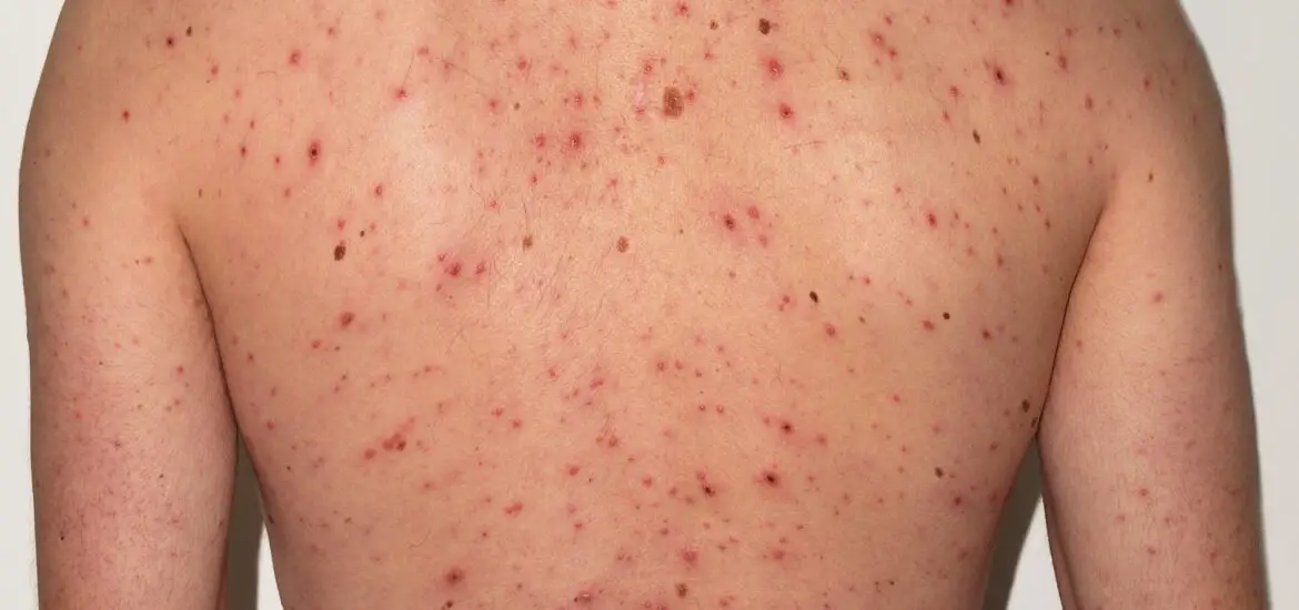 skin after chicken pox