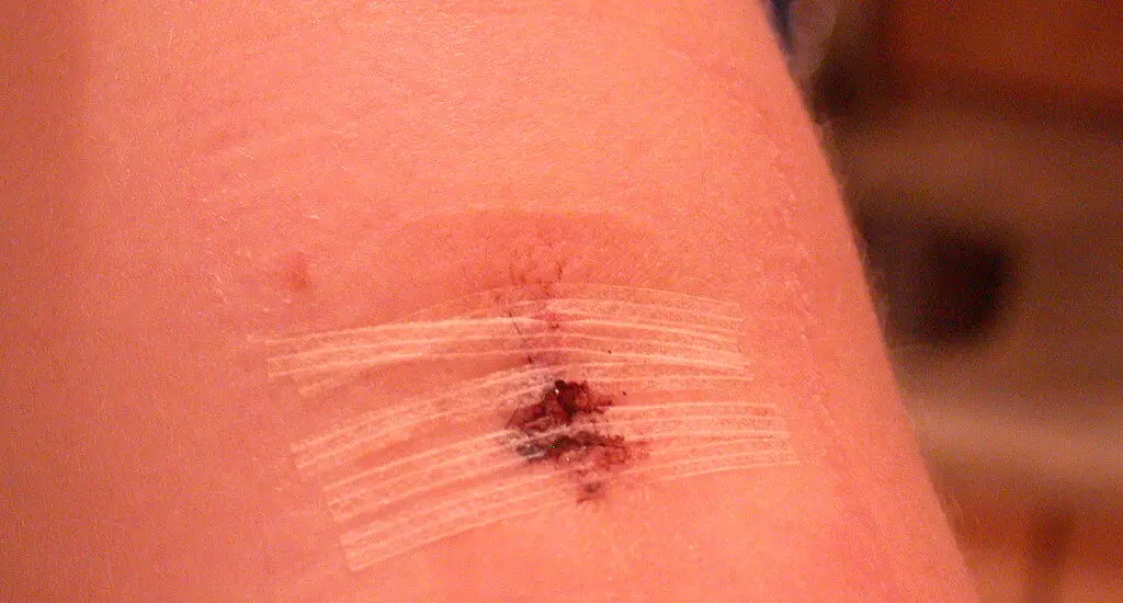 Skin After a Biopsy