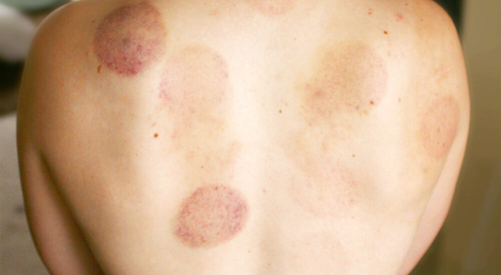 skin after cupping