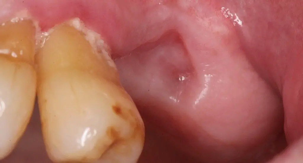What Does the Socket Look Like After Tooth Extraction