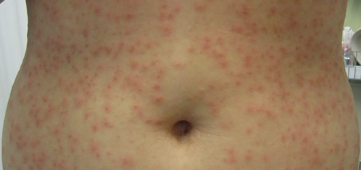 Red Bumps on Skin After Epilation