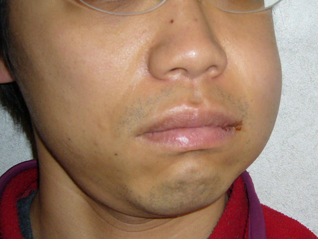 Skin After Wisdom Tooth Removal