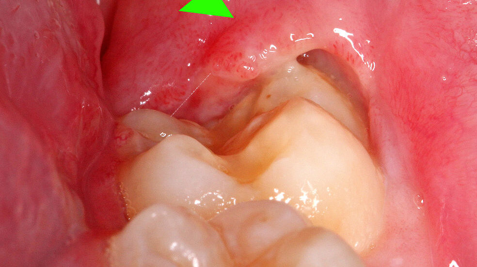 Lump Under Skin After Tooth Extraction