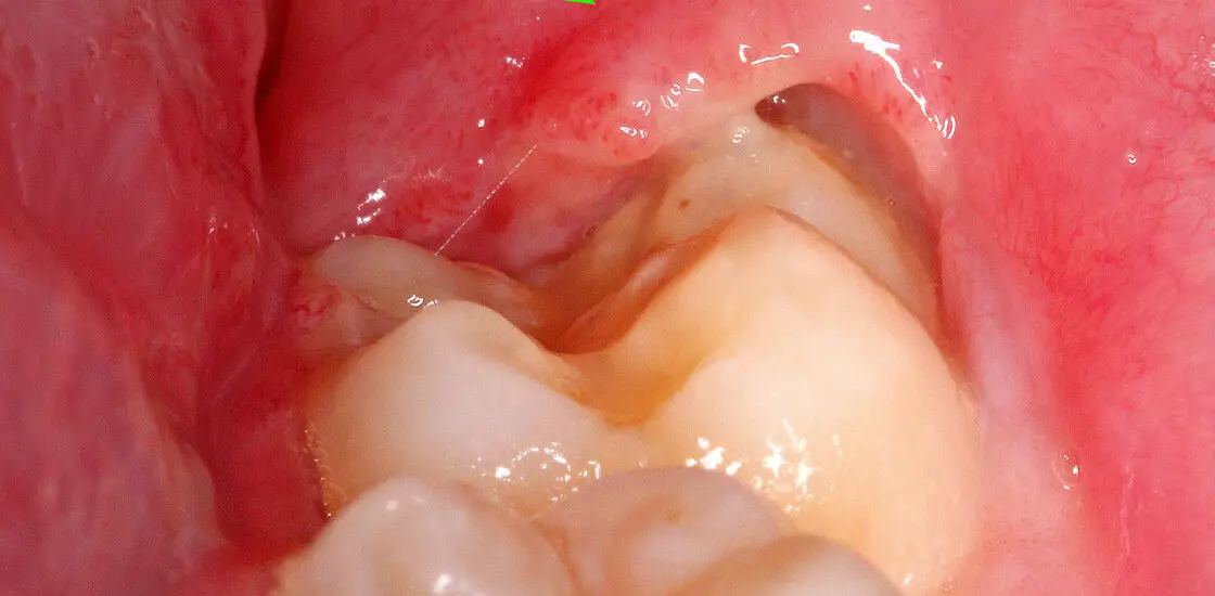 Skin Hanging After Tooth Extraction