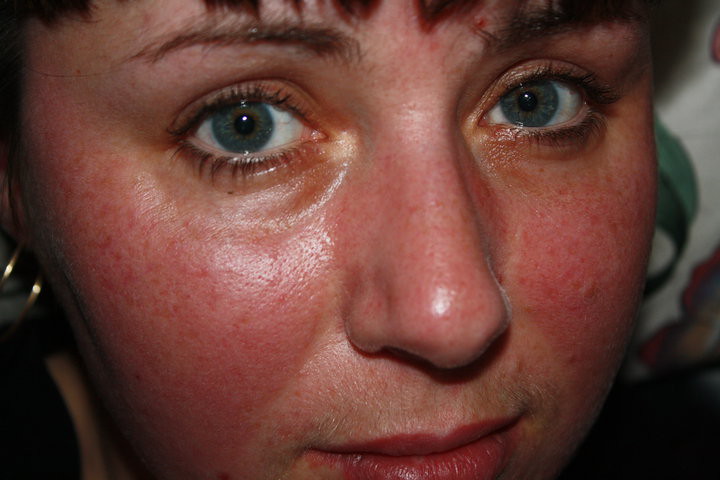 Red Skin After Extractions