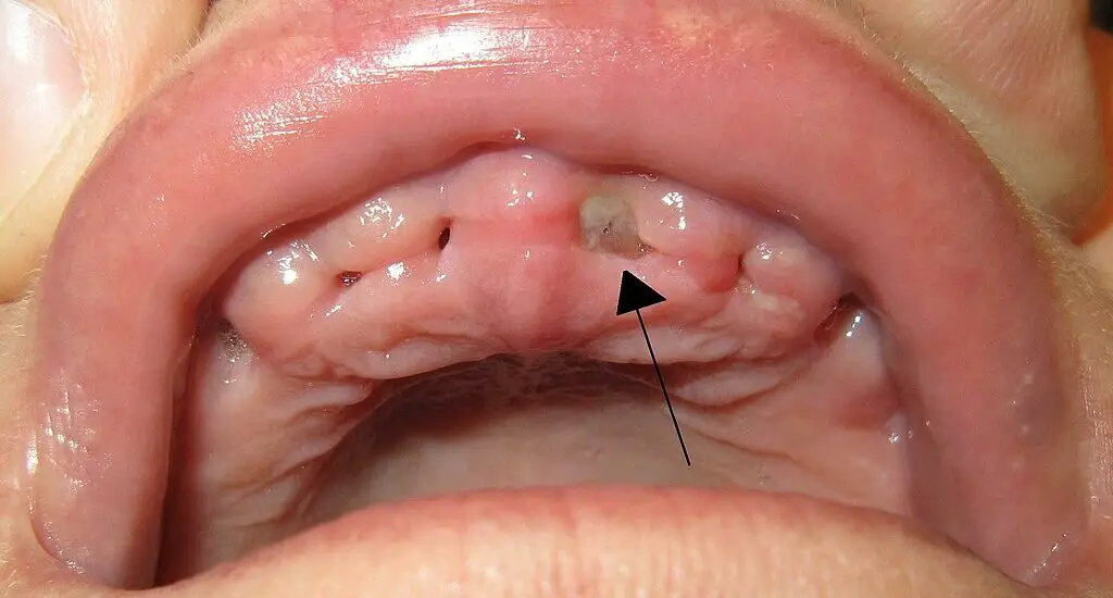 how-to-tell-if-you-have-dry-socket-after-wisdom-tooth-removal