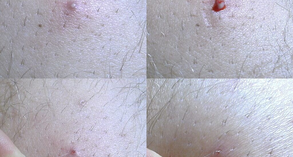 How to Stop Ingrown Hair After Epilation