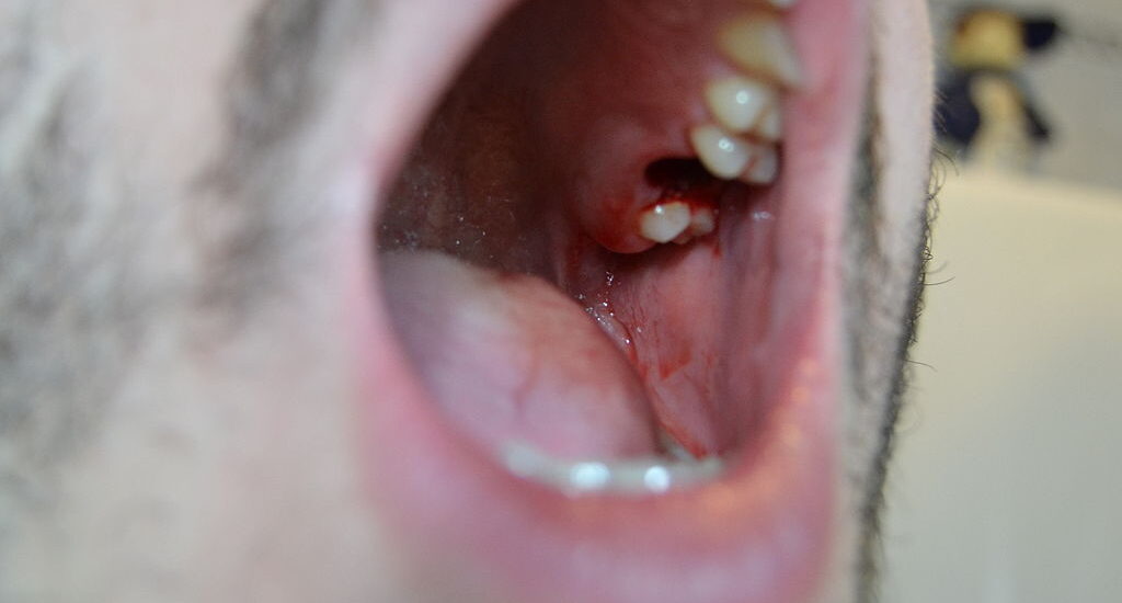 How to Avoid Dry Socket After Wisdom Tooth Removal