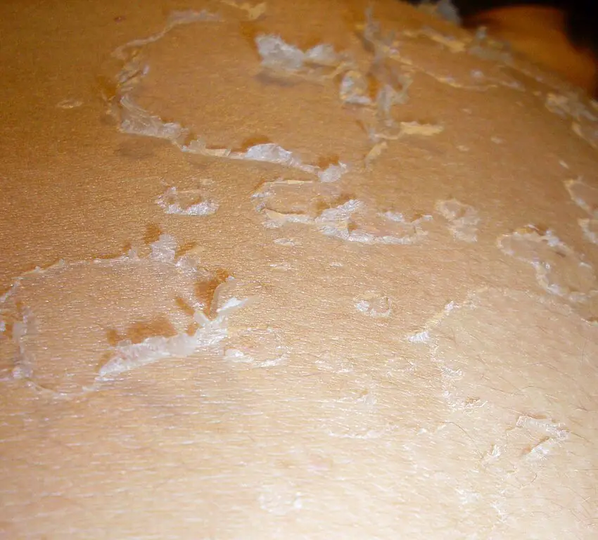 Skin Peeling After Extractions Causes 3 Proven Solutions skin-peeling-after-extractions-causes-3-proven-solutions