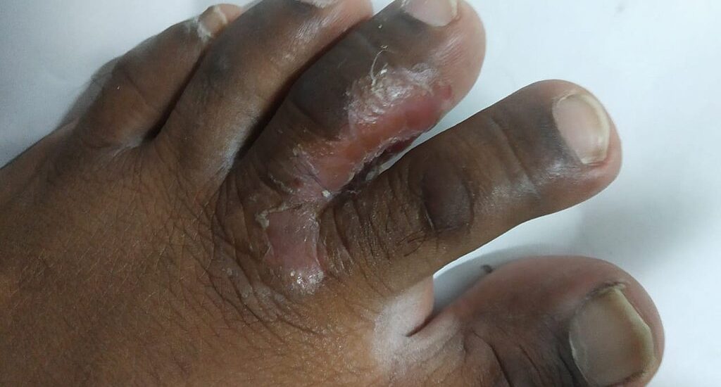 Black Skin After Fungal Infection