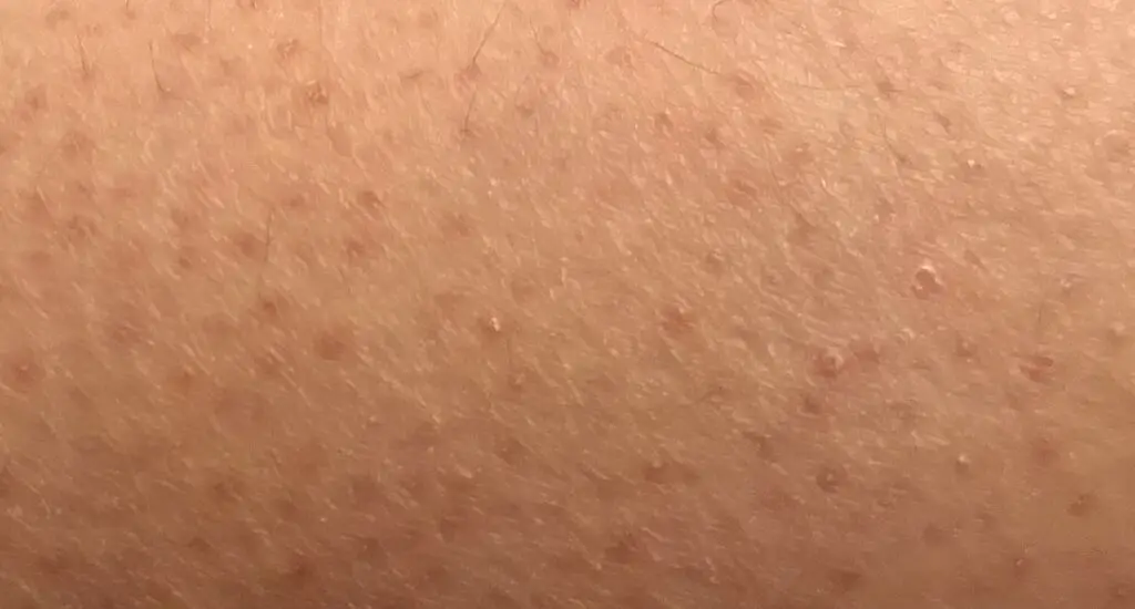Bumps on Skin From Eczema