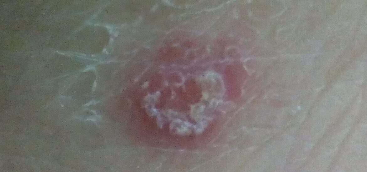 Skin After Fungal Infection