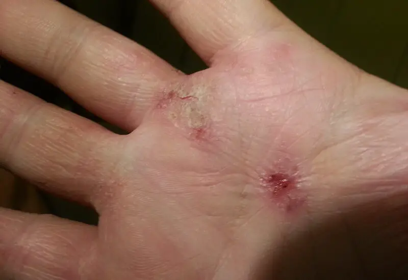 Holes in Skin from Eczema