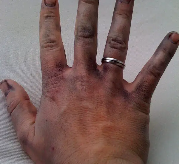 Discoloration of Skin Due to Eczema