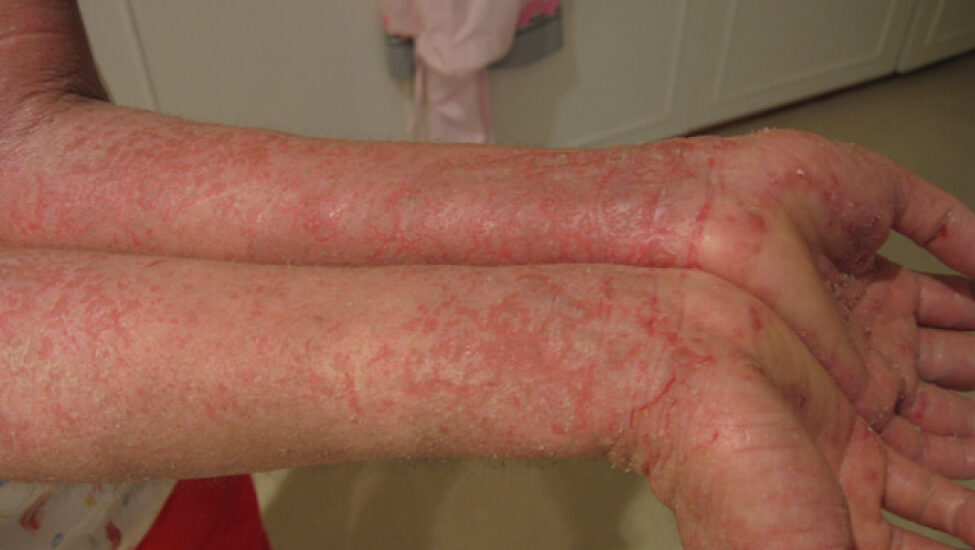 Red Skin After Eczema