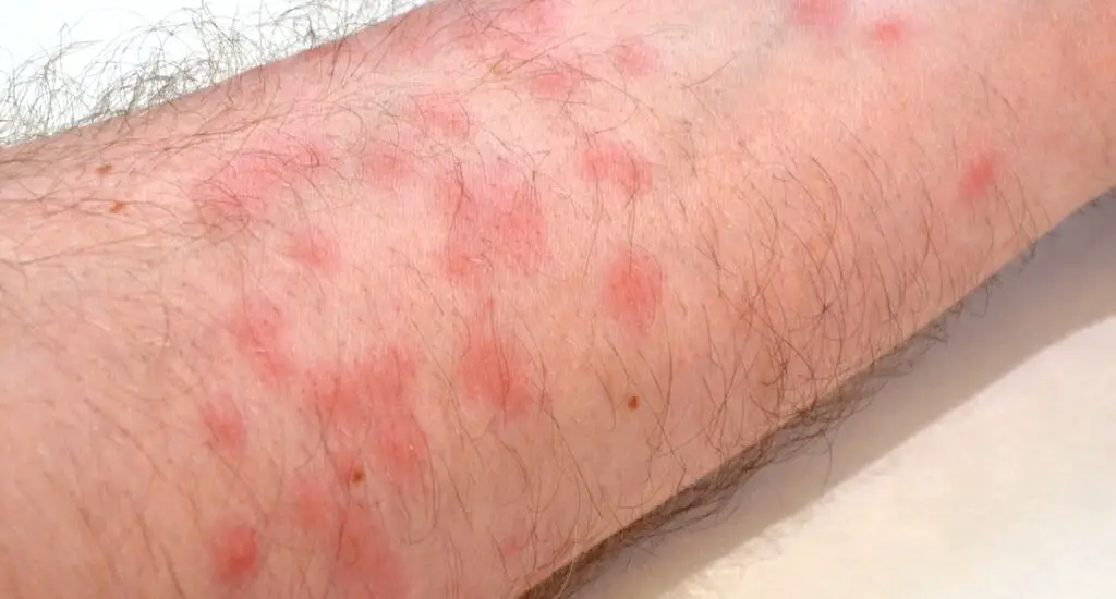 What Causes Blood Spots Underneath The Skin