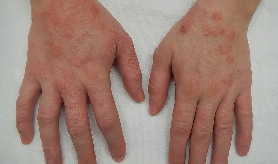 Does Skin Discoloration from Eczema Go Away