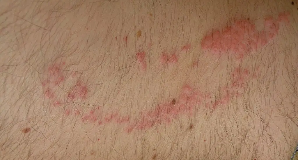 Lines on Skin from Eczema