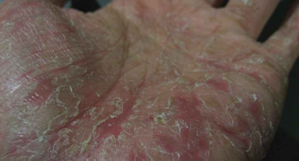 How to Get Rid of Scaly Skin from Eczema