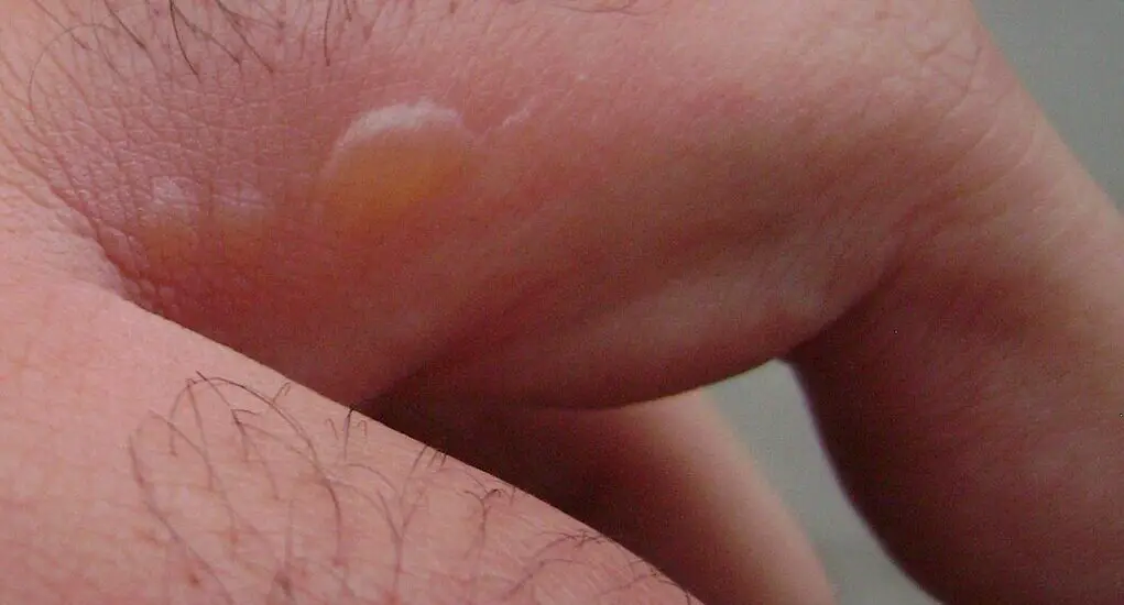Water Bubbles on Skin After Exercise