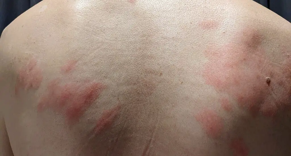 Itchy Red Skin After Exercise