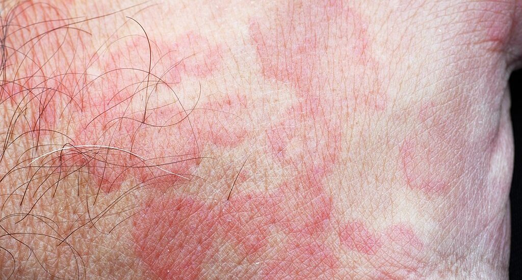 Blotches on Skin After Exercise