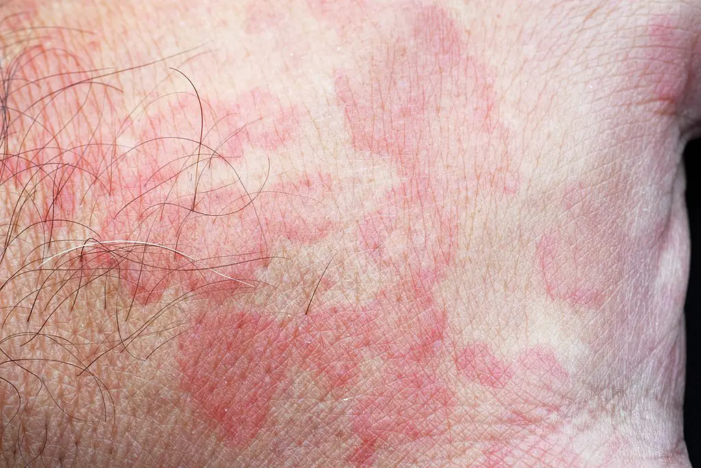 Red Blotches On Skin After Swimming