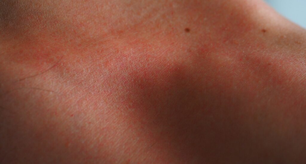 Red Skin After Fungal Infection