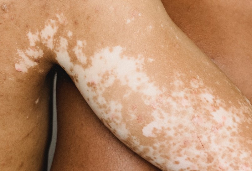 White Patches on Skin After Eczema