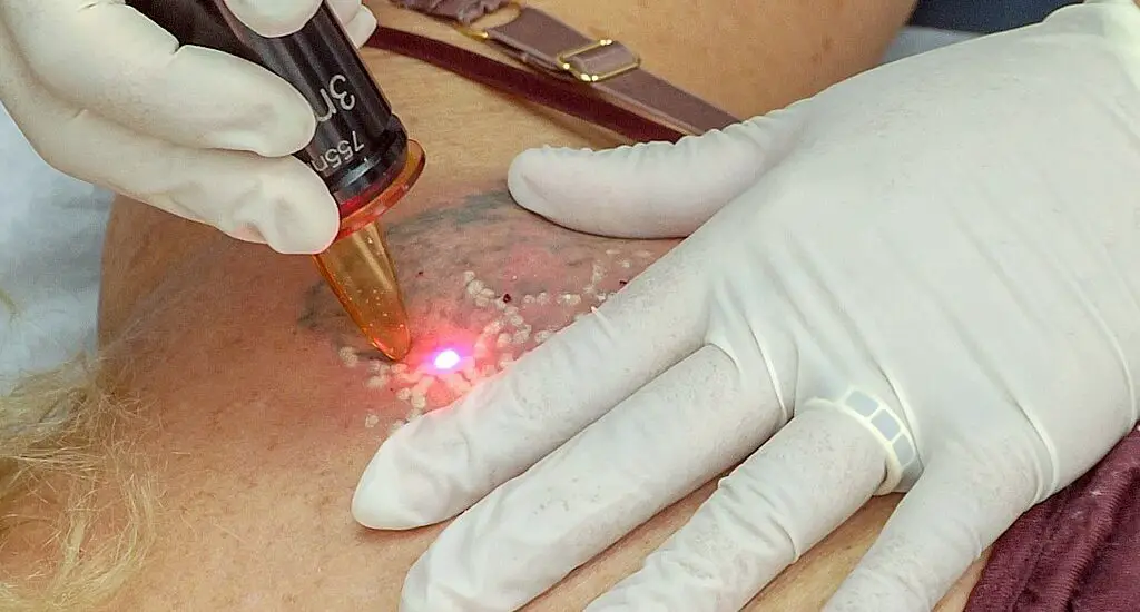 What Causes Blisters After Laser Tattoo Removal