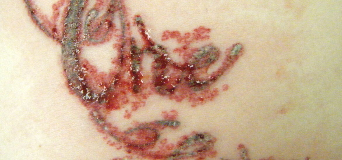 Skin After Laser Tattoo Removal