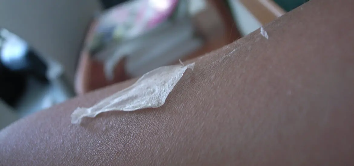 Skin Peeling After Laser Hair Removal