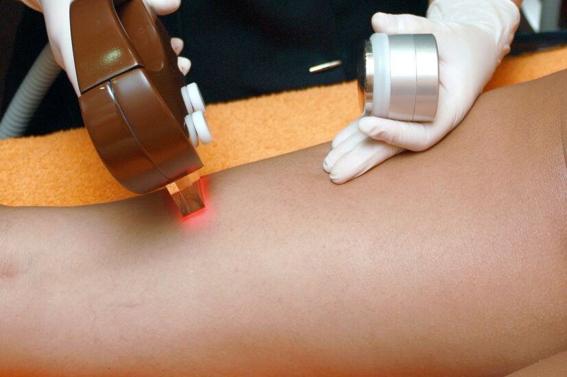 Skin Cancer from Laser Hair Removal