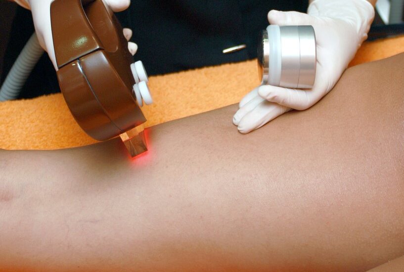 What Happens to Skin After Laser Hair Removal