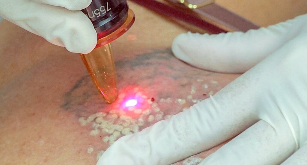 How to Prevent Blisters After Laser Tattoo Removal