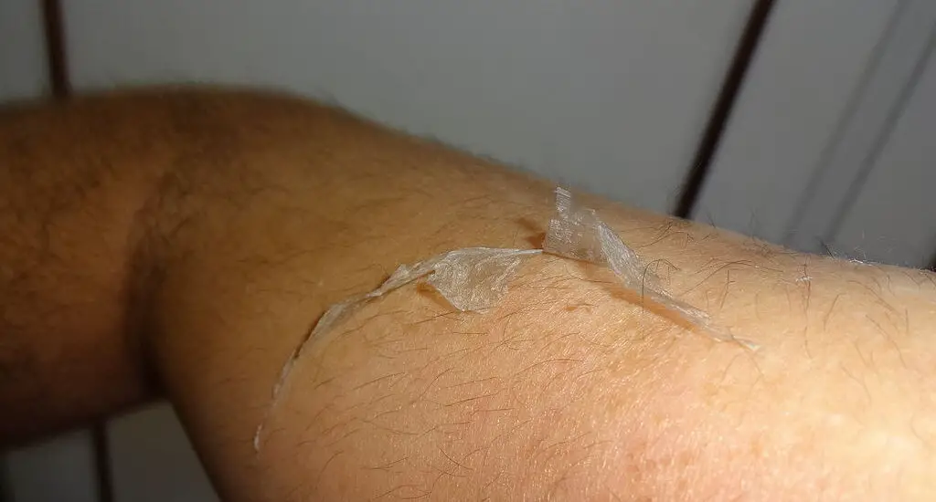 Skin Peeling After Laser Tattoo Removal