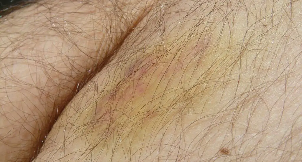 yellow skin after laser tattoo removal
